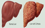 Liver-Cirrhosis