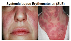 systematic-lupus-erythematosus-SLE