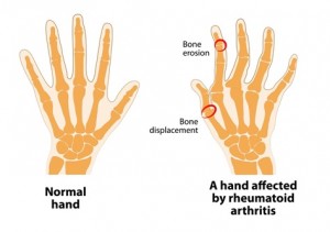 hand-affected-by-arthritis