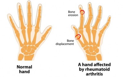 Treatment of Rheumatoid arthritis