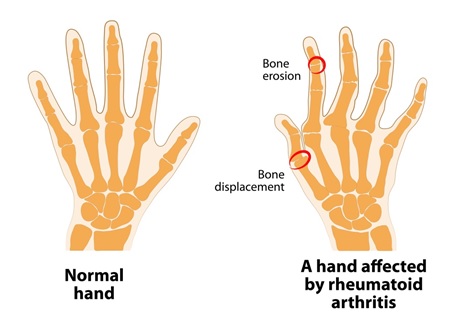 Treatment of Rheumatoid arthritis