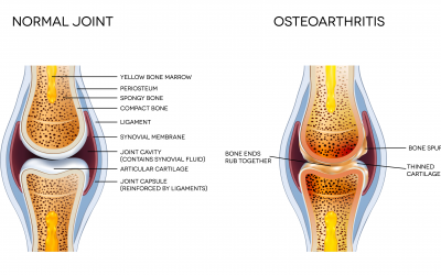 Arthritis, Osteochondrosis – Diseases of the Musculoskeletal System