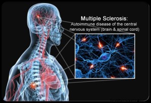 multiple-sclerosis-s1-brain-spinal-cord-nerves